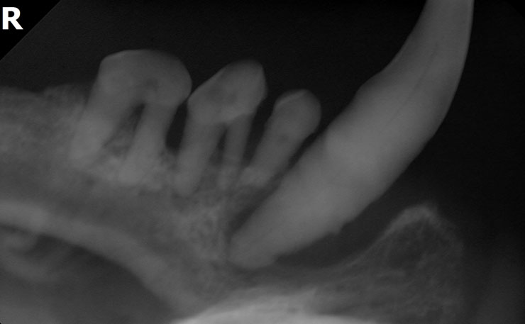 歯周病の歯科治療